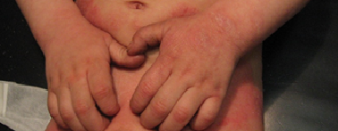 ¿Qué es la Dermatitis Atópica?